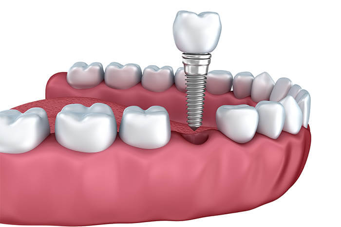Dentist for Implants in Pleasant Hill CA Area