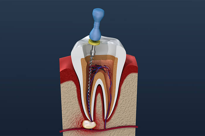 Dentist That Do Root Canals in Pleasant Hill CA Area