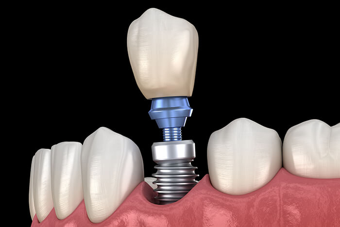 Getting Dental Implants in Pleasant Hill CA Area